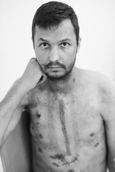 Na zdjęciu młody mężczyzna po przeszczepie serca (w sierpniu 2022)