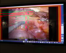 Operacja z udziałem robota Da Vinci w USK