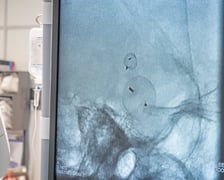 Neurochirurdzy i radiolodzy z Uniwersyteckiego Szpitala Klinicznego we Wrocławiu wykorzystali nowy typ urządzeń do leczenia tętniaków mózgu.