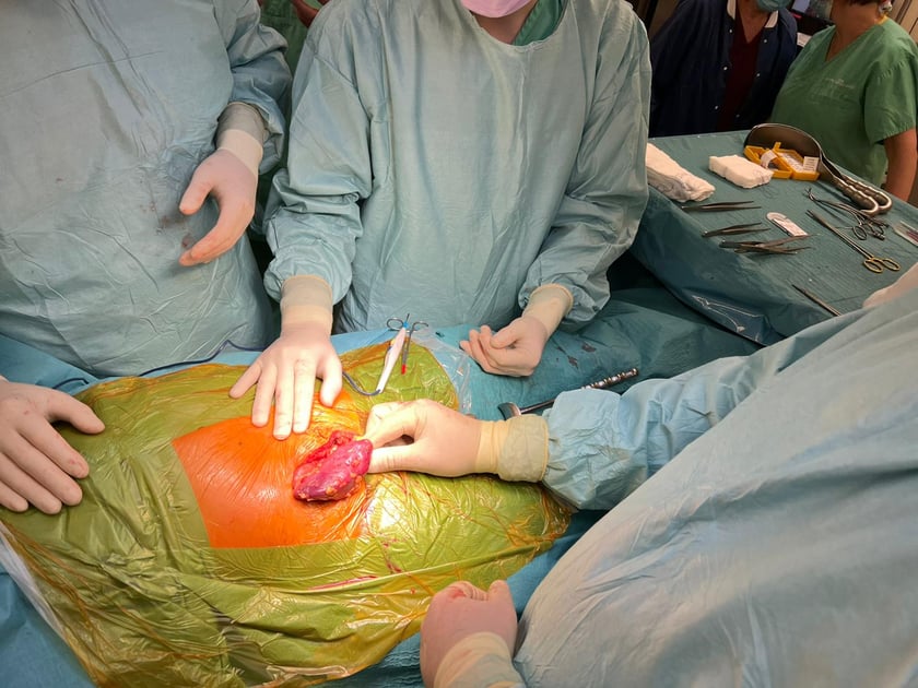 Operacja jednoczesnej retransplantacji serca i przeszczepu nerki