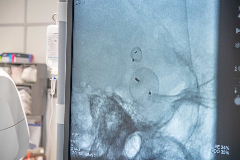 Neurochirurdzy i radiolodzy z Uniwersyteckiego Szpitala Klinicznego we Wrocławiu wykorzystali nowy typ urządzeń do leczenia tętniaków mózgu.