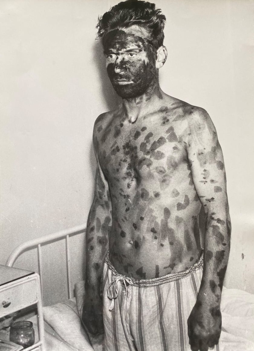 Pacjent z objawami czarnej ospy - Wrocław 1963