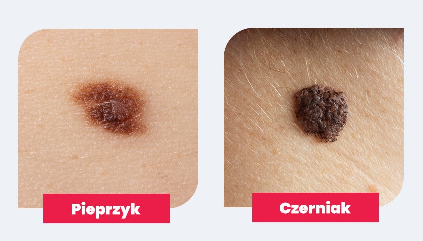 Sprawdź, jak odróżnić pieprzyka od czerniaka