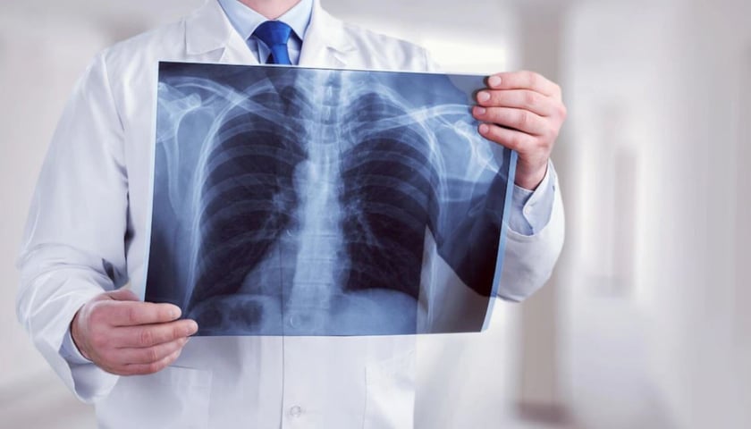 Na zdjęciu: zdjęcie rentgenowskie płuc / zdjęcie ilustracyjne