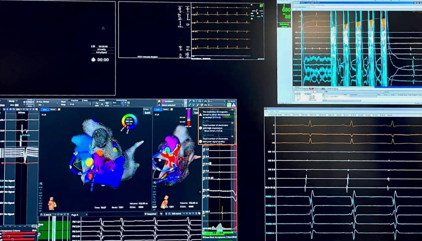 <p>Moment wykonania elektroporacji nawigowanej systemem obrazowania elektroanatomicznego</p>