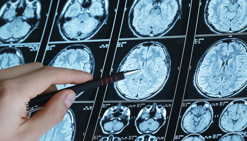 Zdjęcia rezonansu magnetycznego mózgu (zdjęcie ilustracyjne)