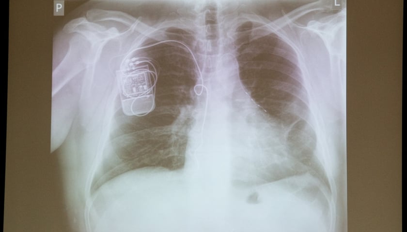 Śpią lepiej dzięki stymulatorowi