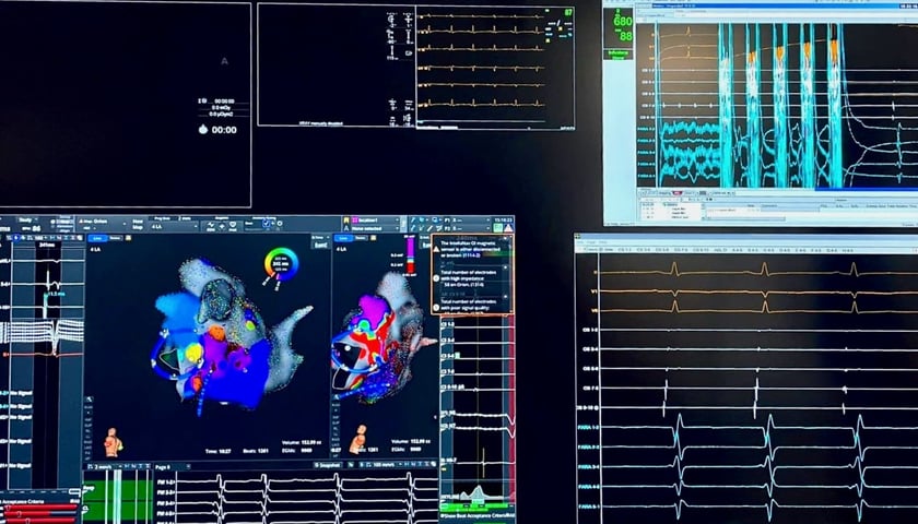 Powiększ obraz: <p>Moment wykonania elektroporacji nawigowanej systemem obrazowania elektroanatomicznego</p>