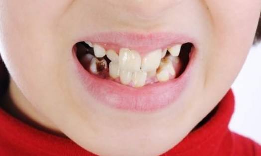 Profilaktyka próchnicy zębów u dzieci w wieku przedszkolnym
